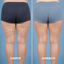 Lade das Bild in den Galerie-Viewer, Formkur - Anti-Cellulite Massagegerät für Bauch, Beine & Po